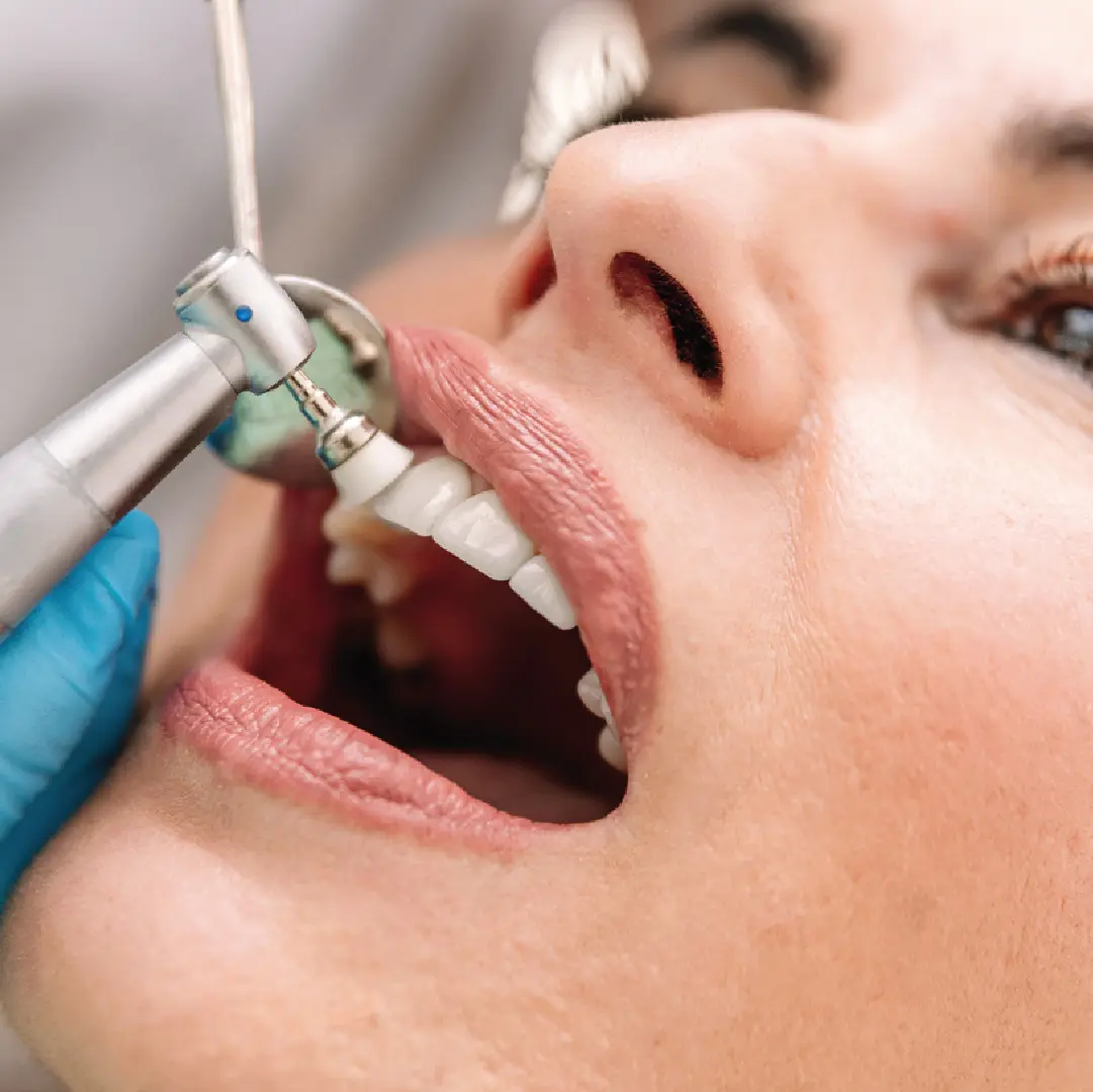 blanquejament dental a santpedor