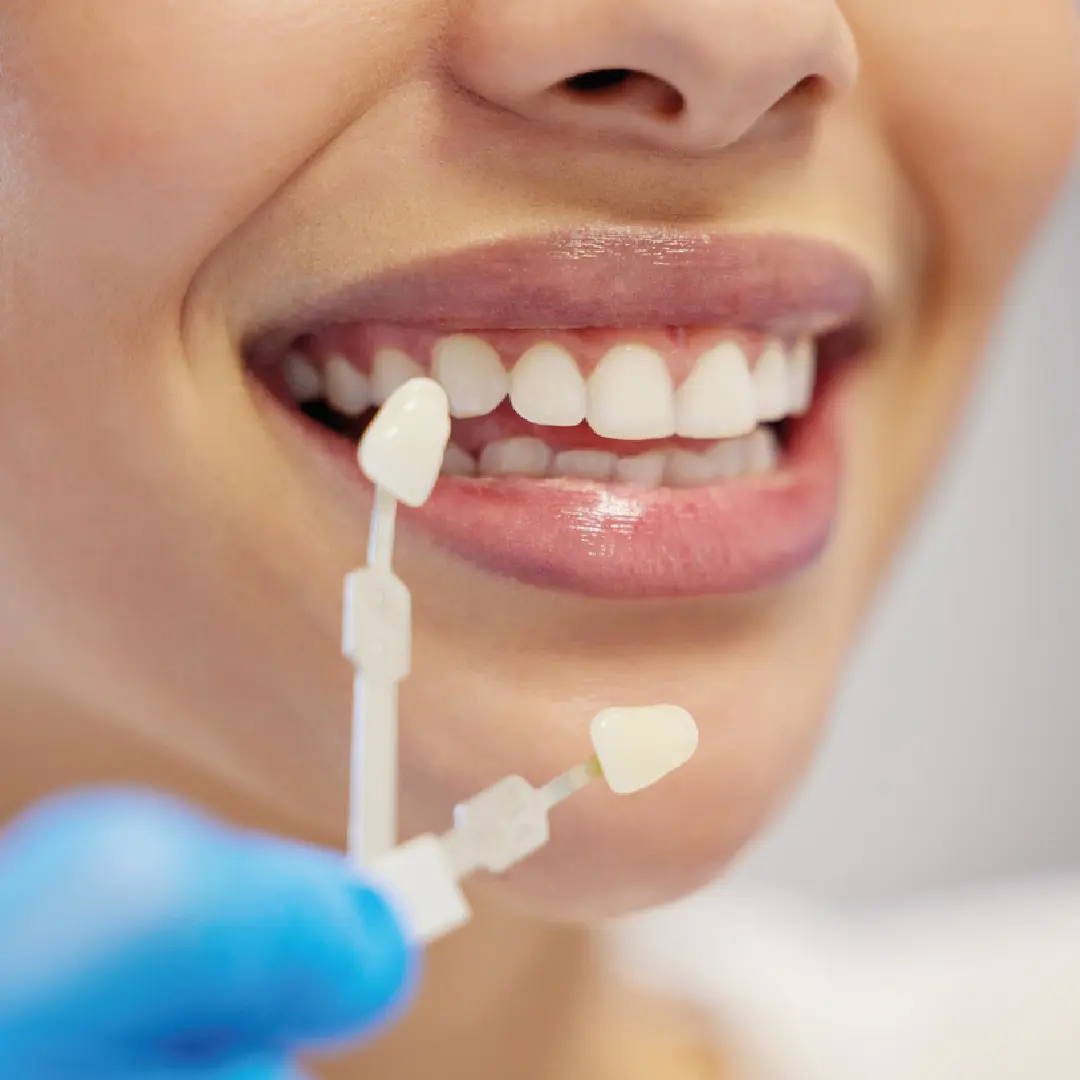 carilles dentals de resina santpedor