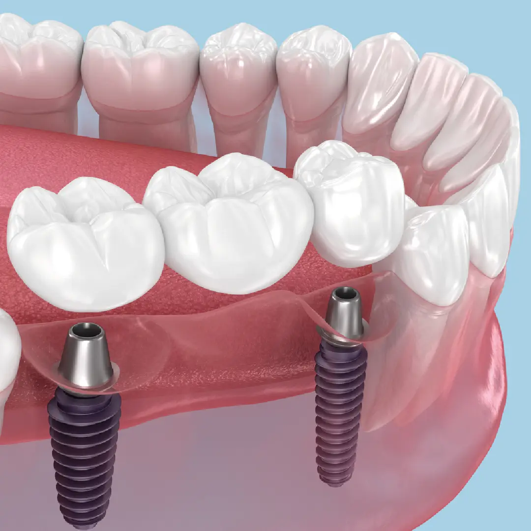Pont dentals sobre implants
