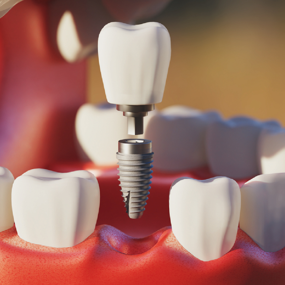 implantologia dental individual